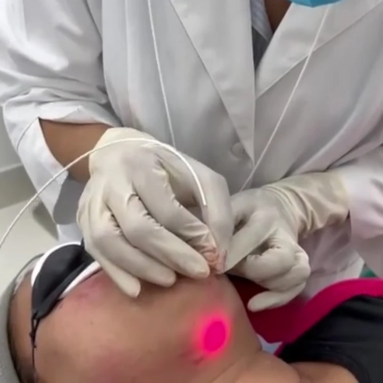 2024 professional endolaser 1470nm fiber laser face lifting 980nm skin tightening facial machine