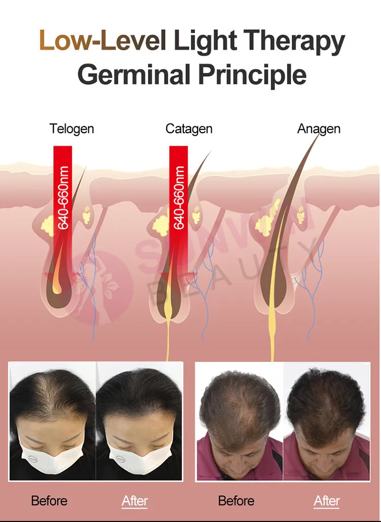 Helmet Rechargeable Diode Light Laser Hair Growth Helmet For Anti-Hair Removal Laser Hair Regrowth Therapy
