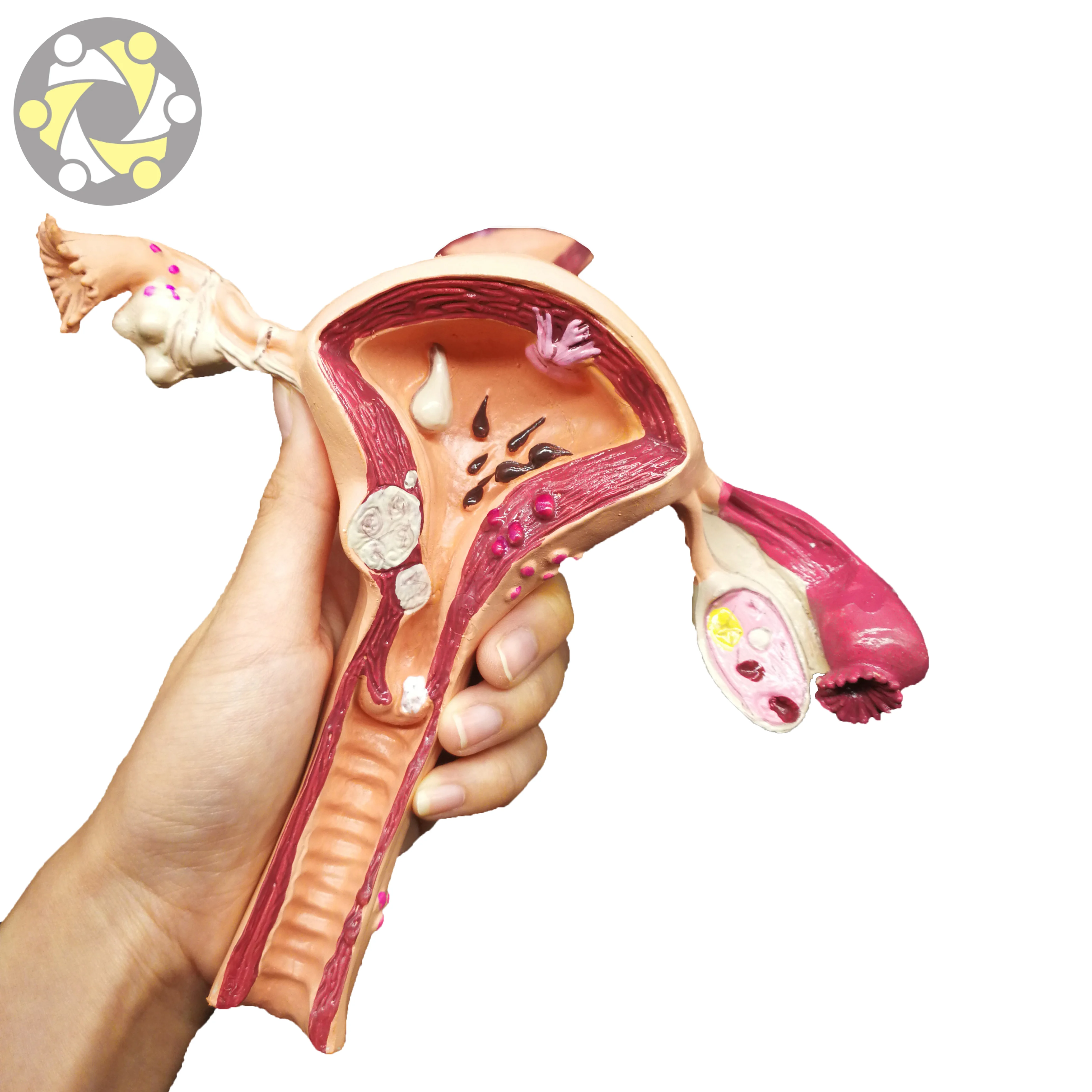 Female Uterine Fibroids Pathological Anatomical Model PVC Material for Medical Science and School Usage