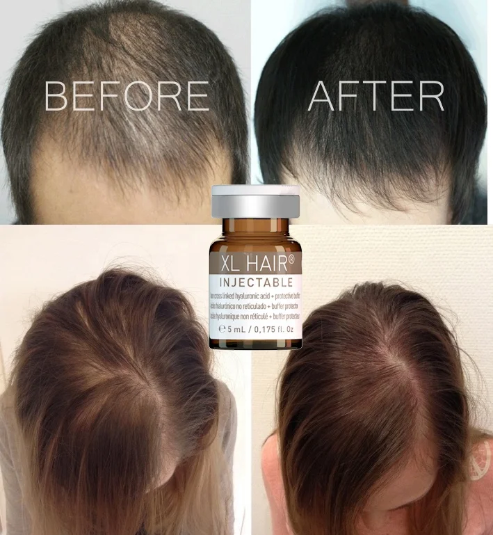 Professional meso therapy peptide hair growth ampoules for hair loss