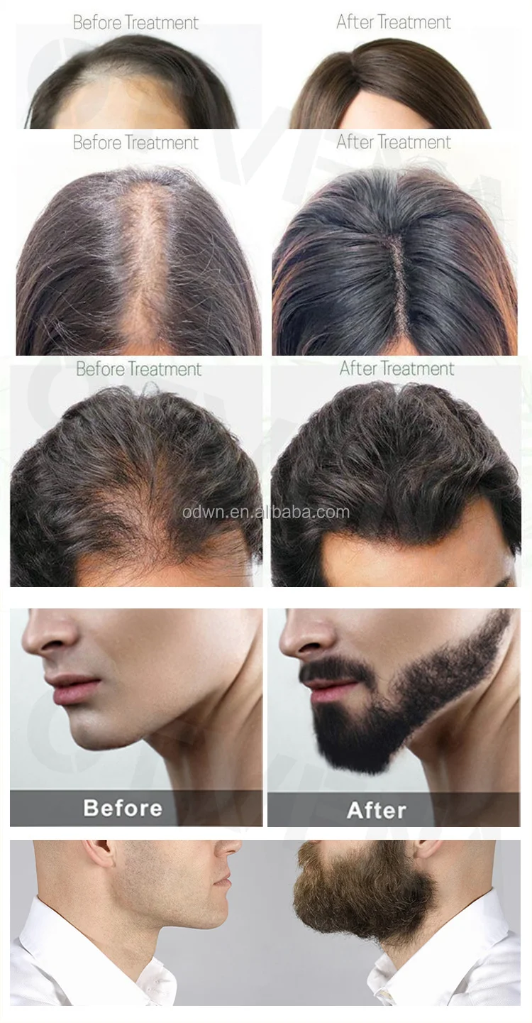 Women Men Anti Hair Loss Treatment Organic Ginger Hair Growth Oil For Hair Regrowth Spray