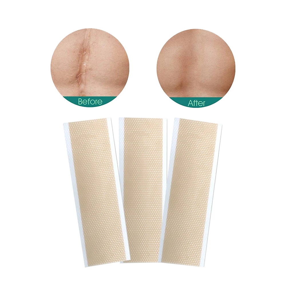Scar sheets reusable scar tape for c-section keloid bump stretch marks burn tummy tuck surgical scar removal