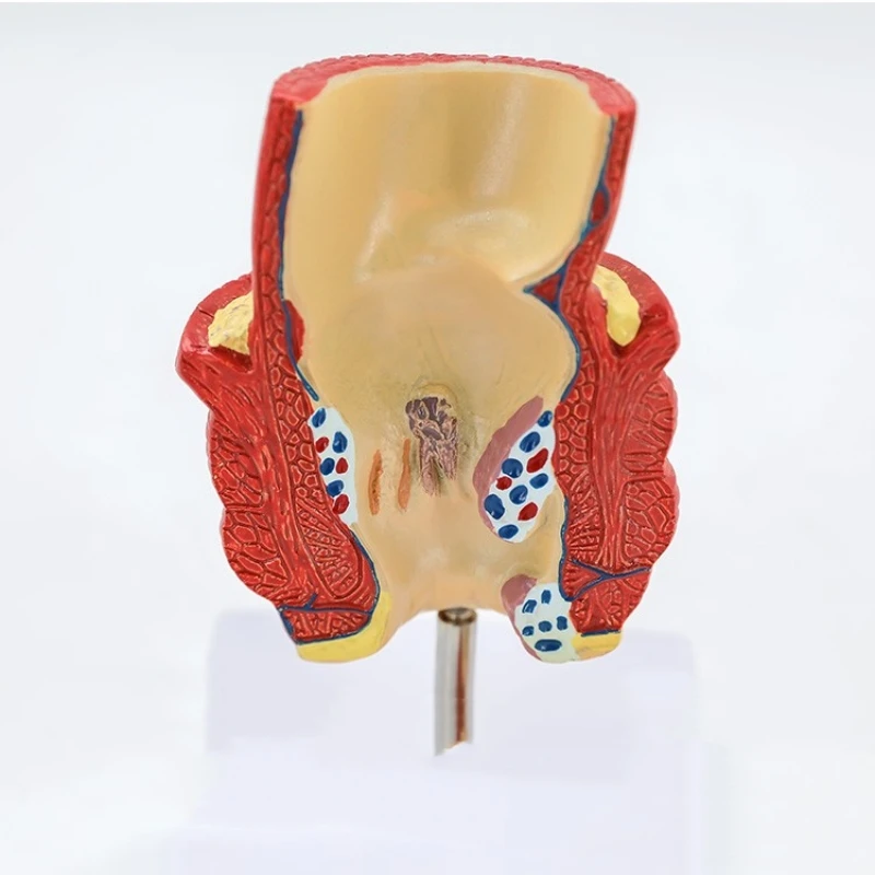 rectal hemorrhoids colorectal disease model Internal and external rectal hemorrhoids anorectal model