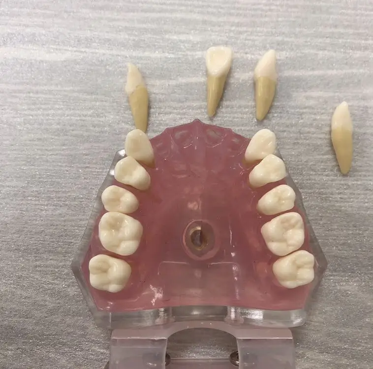 Dental Tooth Extraction Model with Soft Gum and Removable Teeth