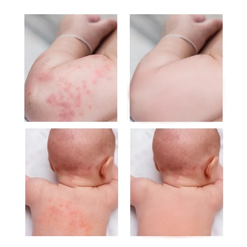 OEM ODM полноэффективный Восстанавливающий детский подгузник лечение сыпи псориаз хороший крем от экземы псориаза гербики