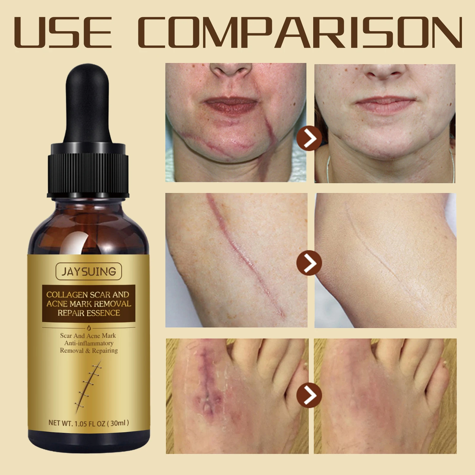 Hot Selling Natural organic fade Caesarean scar surgery scar to burn marks repair and smooth skin scar essential oil