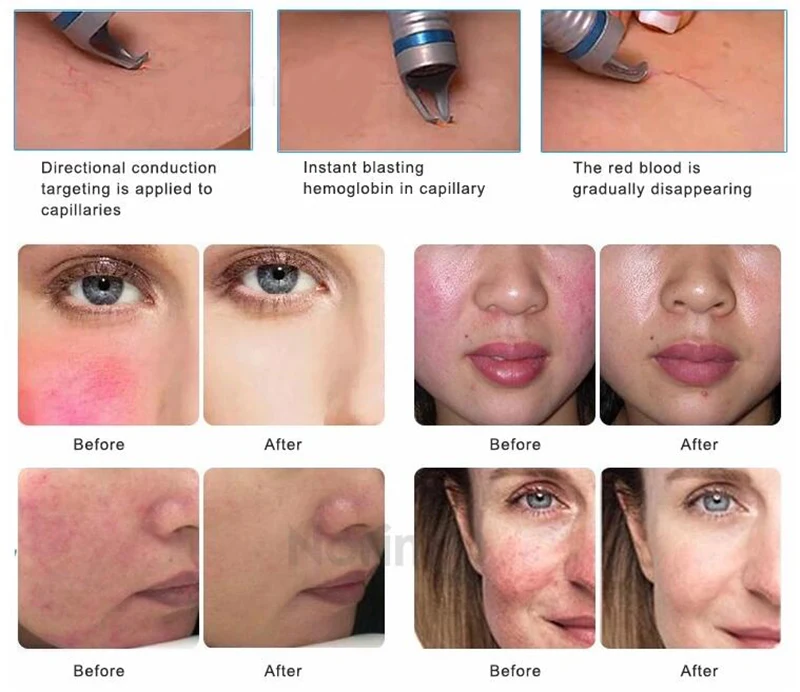 Red Blood Vessels 980nm Spider Veins Removal Diode Laser 980 nm Varicose Veins Laser Treatment Machine