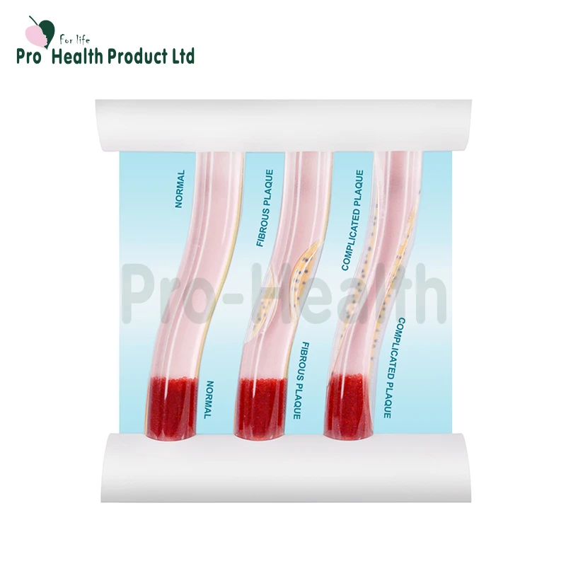 Dynamic vascular Blood Vessel Educational Teaching Model, LDL Low-density Lipoprotein Vascular Disease Model