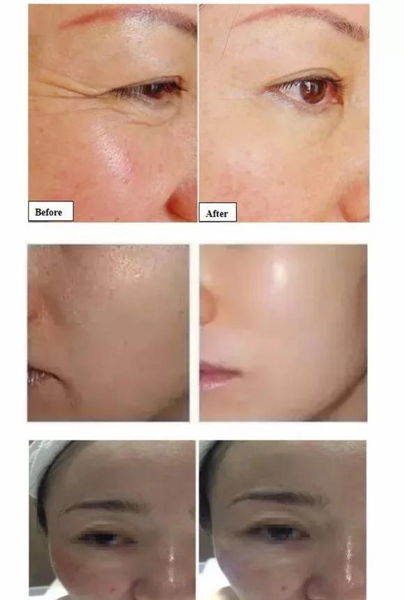 Water Jet Machine Face And Neck Lifting Massager Anti Wrinkle Face Lifting Machine