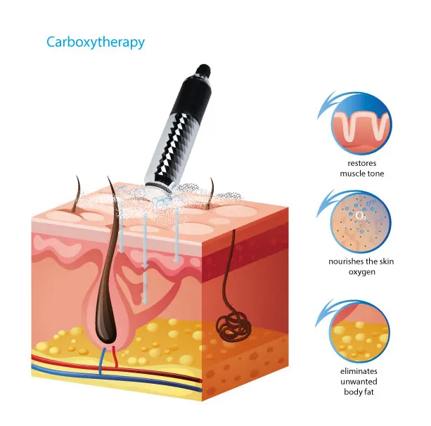 N2O Liquid Nitrogen Cryo Spray Eye wrinkle removal freeze Pen Mole Removal Skin lifting Cryopen Co2 carboxy therapy device