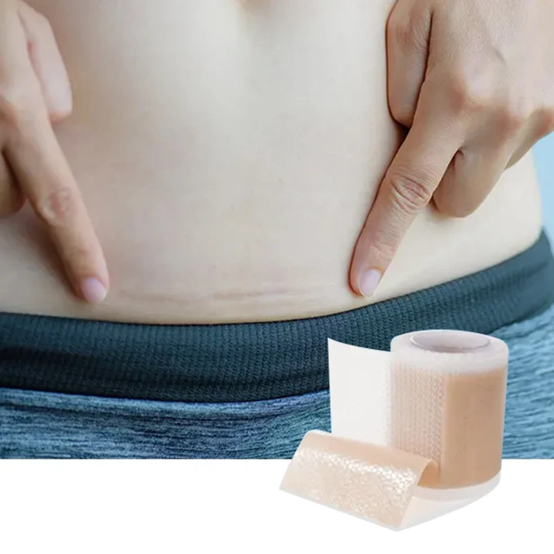 Professional Caesarean Sacr Silicone Scar Removal Gel Tape Waterproof 1.5m Length Roll Silicone Scar Sheets