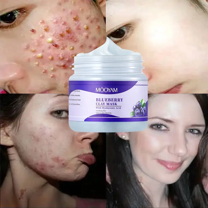 Face Clay Mask Skin Care Beauty Products Acne Remover Anti Acne Blueberry Purifying Mask Facial Clay Mud Mask
