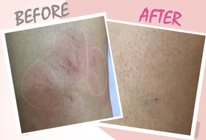 OEM logo Sincoheren Italy Pump Germany Bars 808 Alexandrite Laser 755 nm For Permanent Hair Removal  for Aesthetic Used Laser