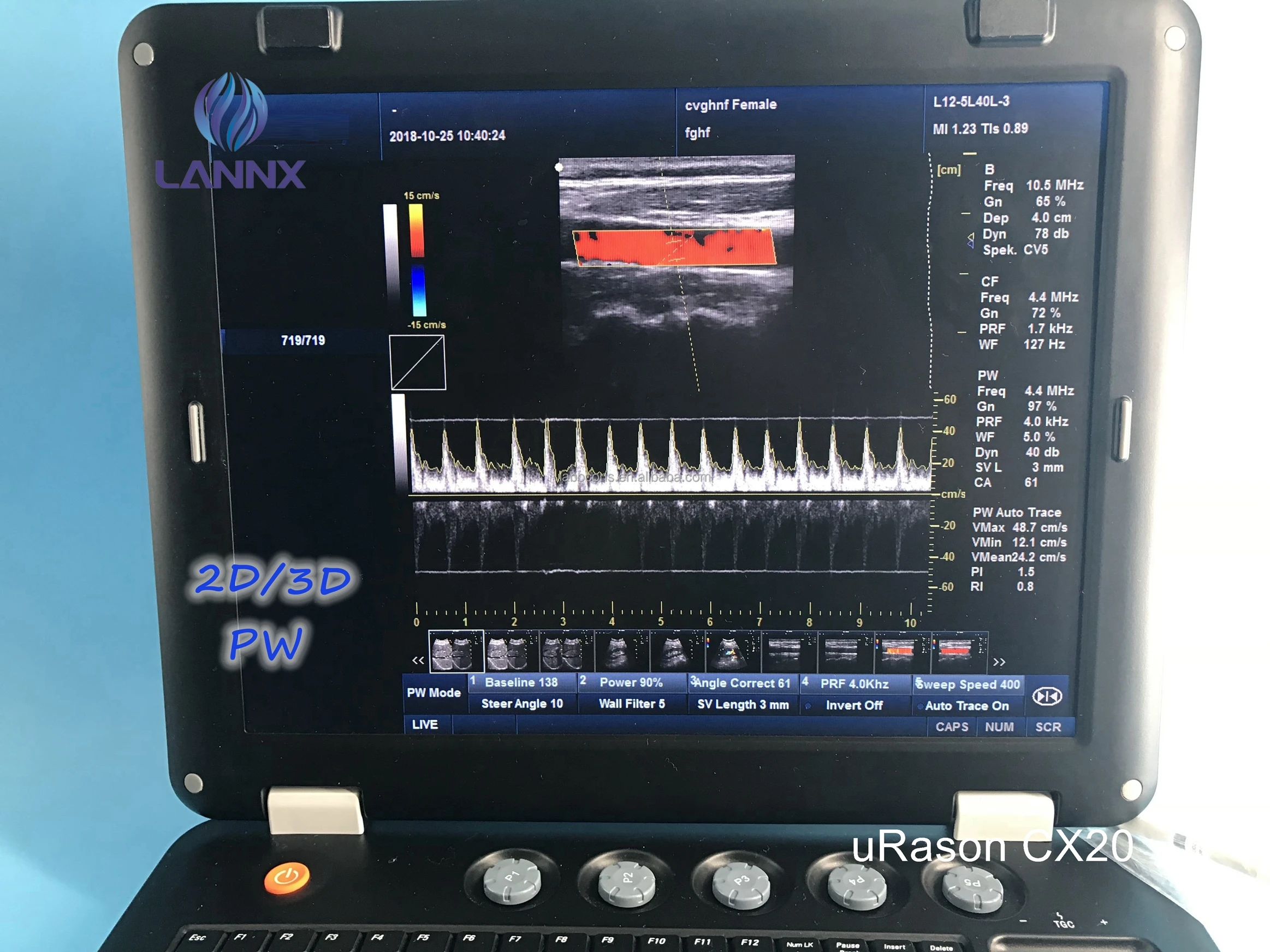 LANNX uRason CX20 Hot selling portable ultrasound 128 elements 2D/3D color doppler ultrasound for hospital ultrasonido portatil