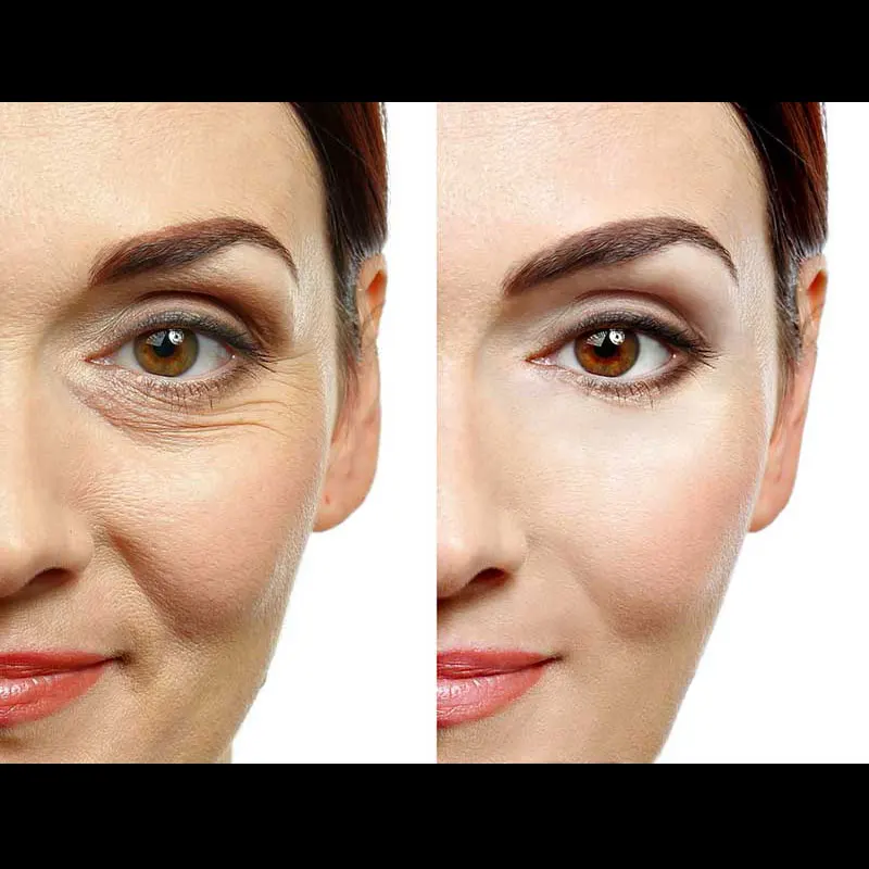 30g 25mm 38mm mono screw korea medical polydioxanone absorbable skin lift suture cannula hilos pdo eye thread