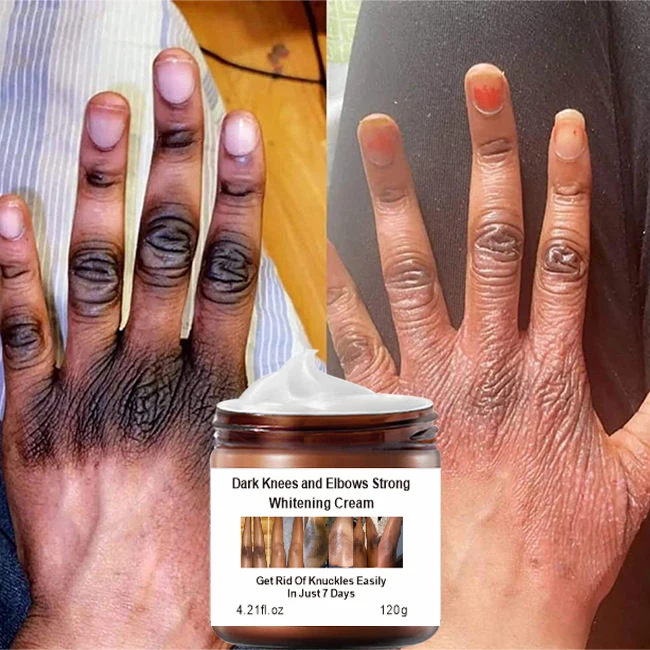 wholesale niacinamide dark knees knuckles elbows armpit whitening cream,woman private parts snow bleaching cream for dark skin