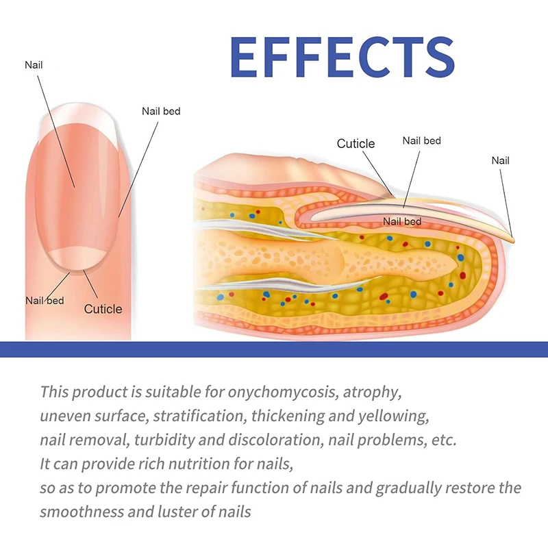 Restores Healthy Appearance Nighttime Renewal Fungal  Overnight Nail Treatment Patches for Nail Fungus Damage