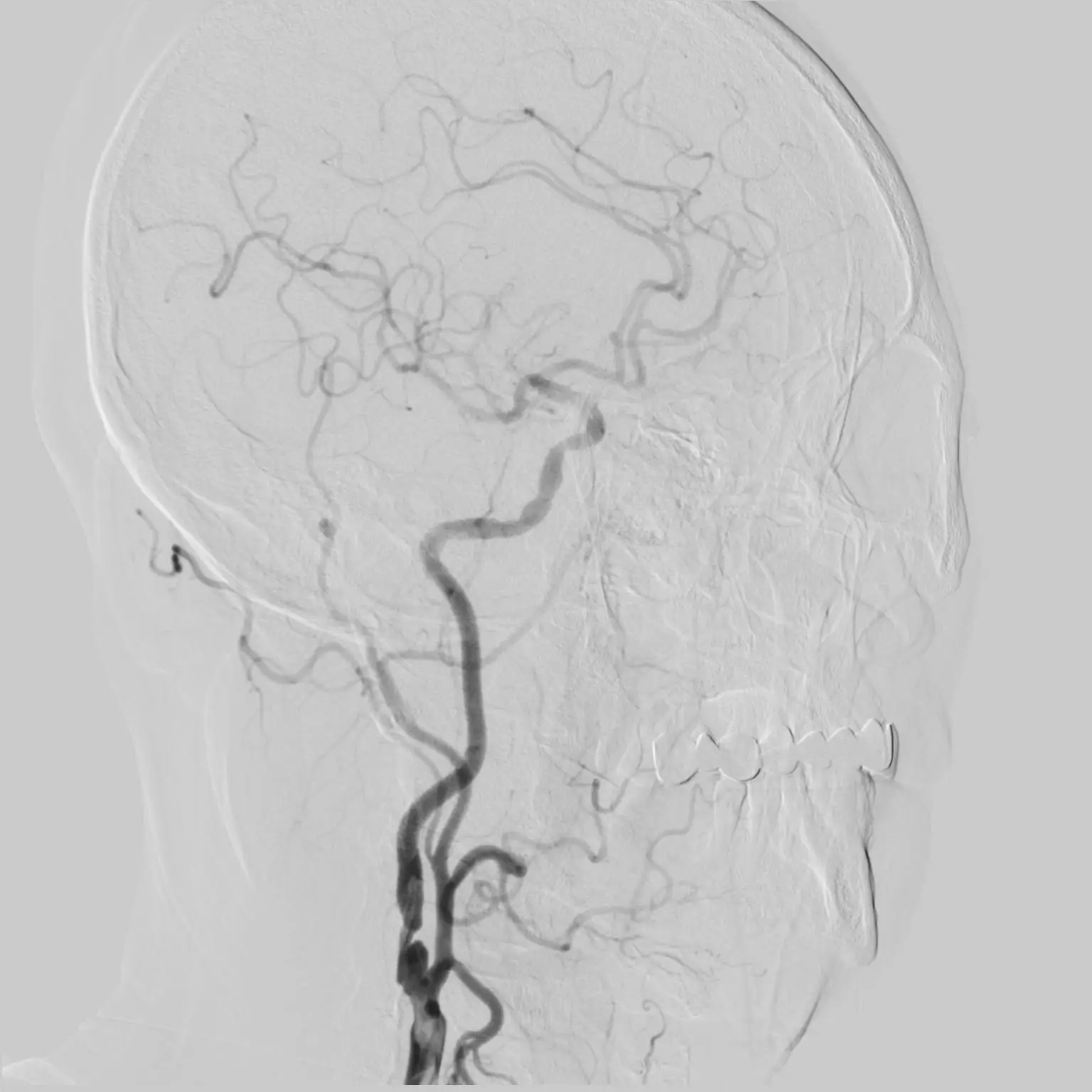 Medical DSA System With Liquid Metal X-ray Tube Heat Capacity 2.6 MHU
