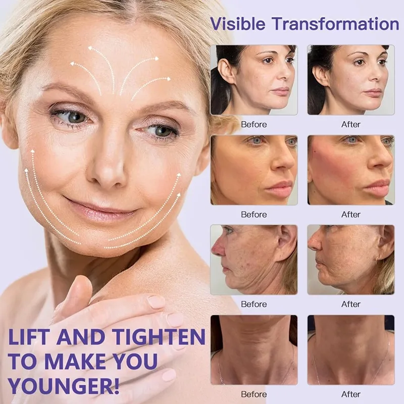 korean PDO thread lift Ultra V line 18g COG 3D 4D 6D W / L Blunt Cannula Face Lifting Thread For Face And Body