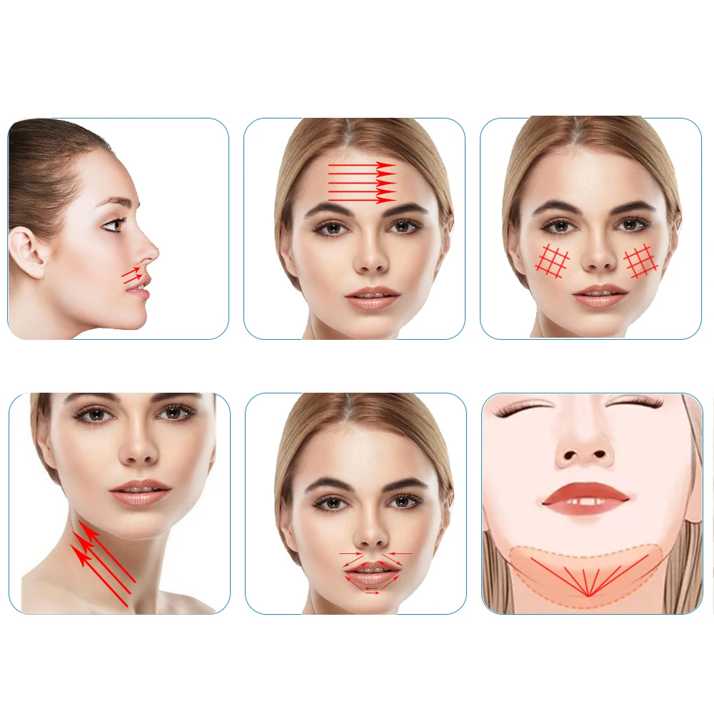 Sharp Needle Monkey Hilos 27g 50mm Forehead Cheek Filling Smooth Pcl Mono Thread