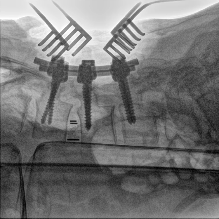 ISO 13485 Approved Mobile/Portable C-Arm Digital X-ray Machine Manufacturer
