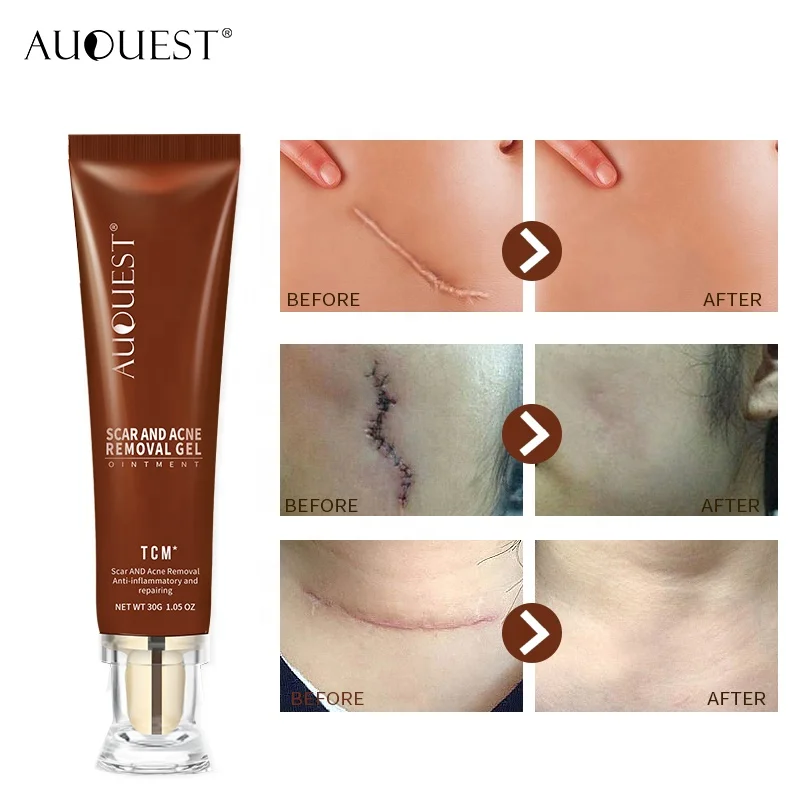 Professional facialtcm scar and acne mark removal gel ointment best south korea acne scar removal