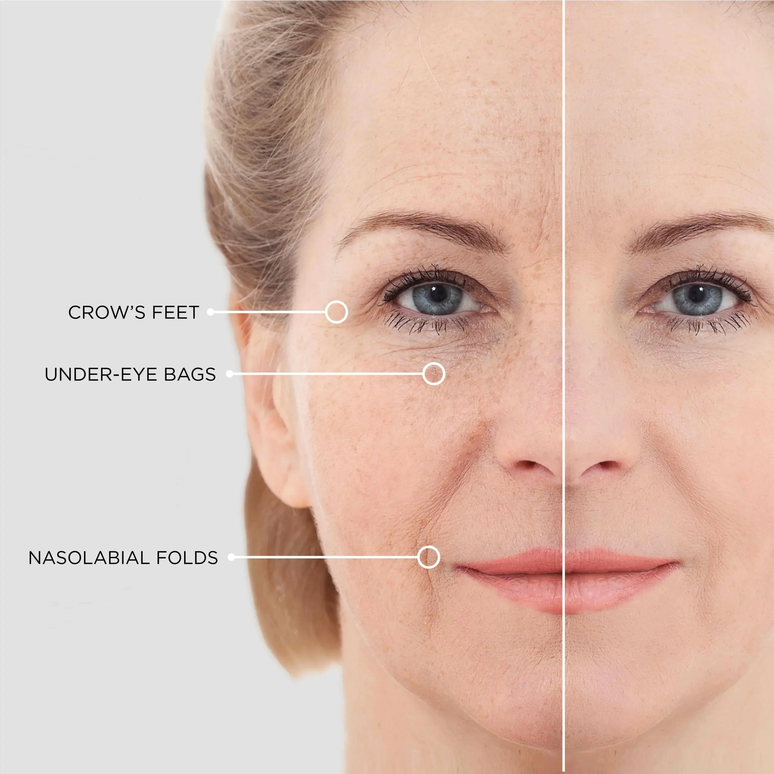 Micro Dart Patch Custom Eye Patches Antiwrinkle With Microneedle Collagen Micro-needle Eye Patches