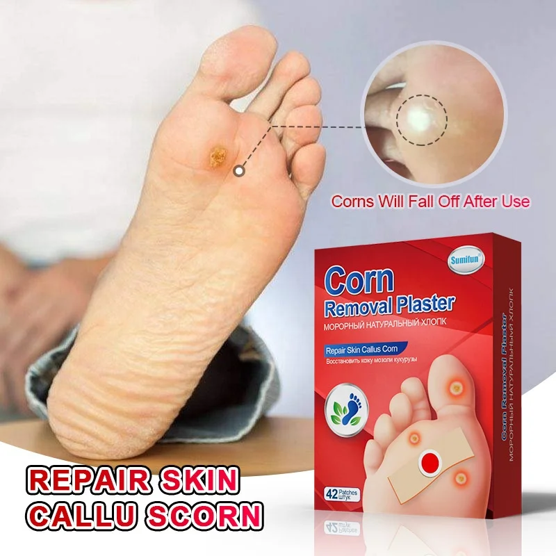 Rehabilitation treatment supplies health medical corn paste foot callus ointment
