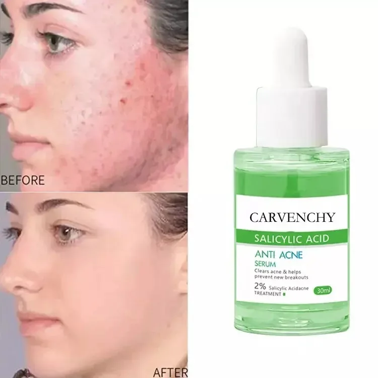 Acne Breaking Serum Anti Acne Salicylic Acid Acne Scar Removal Treatment Skin Care Face Serum