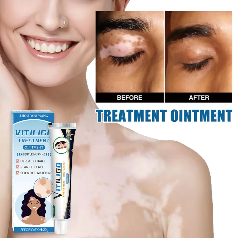 20g vitiligo ointment Body white spots pigmentation skin itchy scars vitiligo