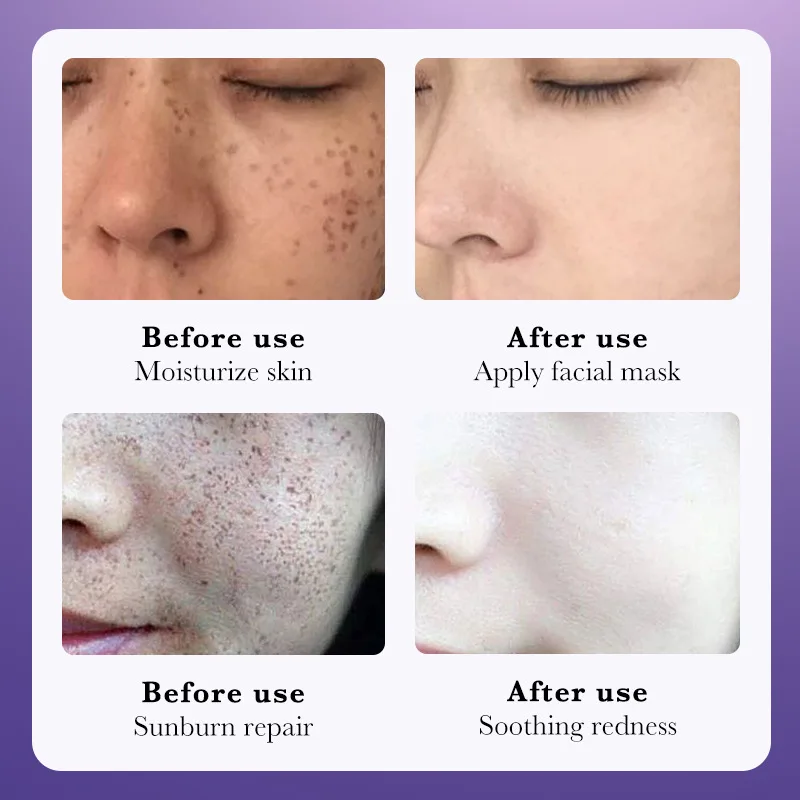 SADOER Nicotinamide Whitening and Freckle Removing Cream moisturizing nourishing face acne cream