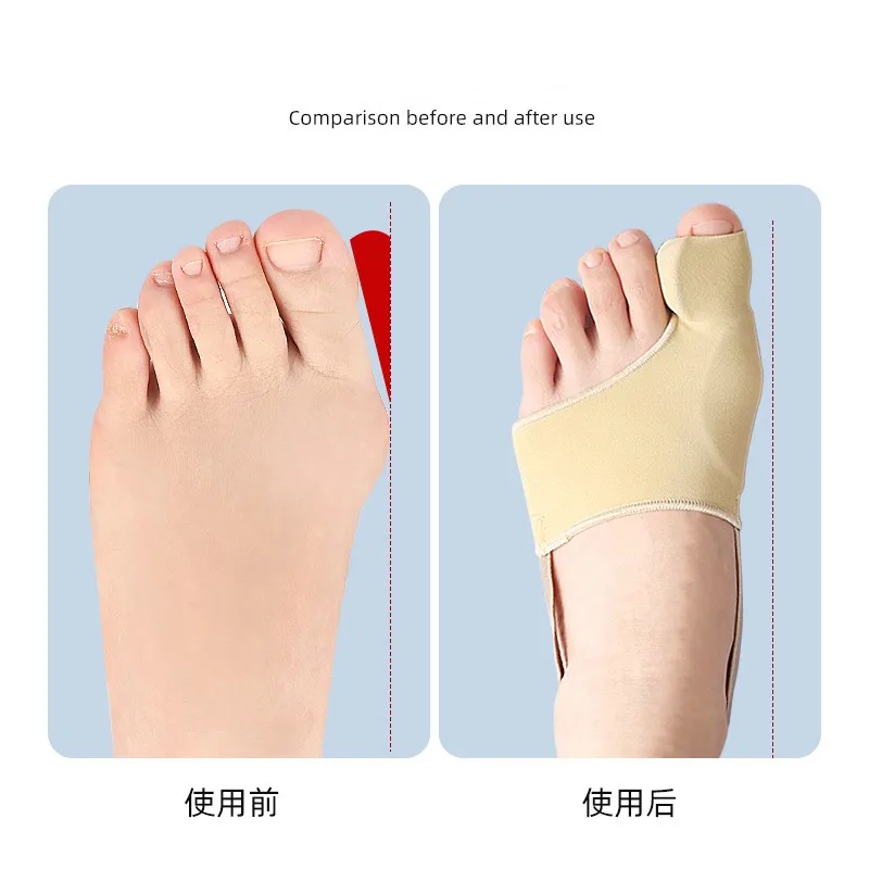 SEBS hallux valgus foot guards
