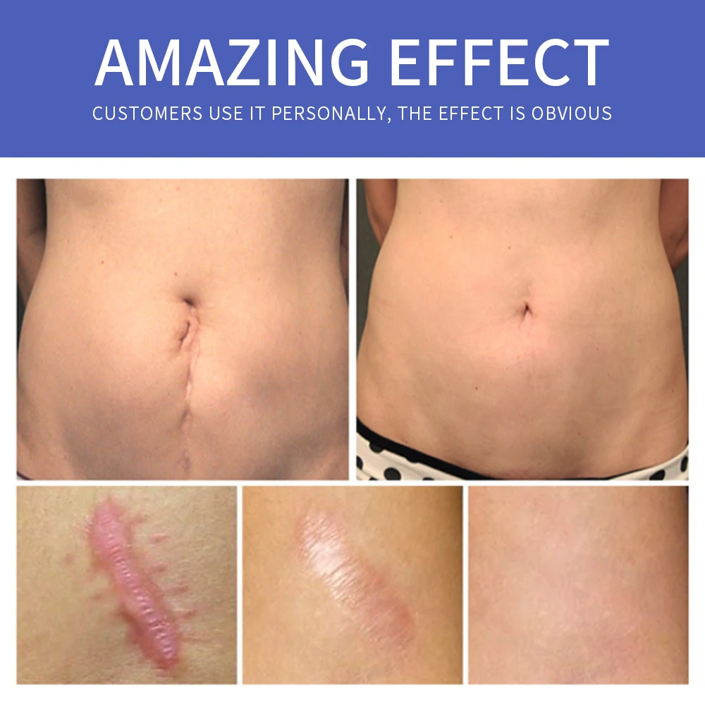 stretch mark cream natural organic stretch mark repair cream private label
