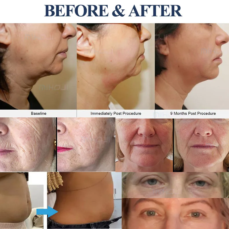 Smas hifu 12d face and body 8d 7d facial y corporal cartridges hifu machine 7d mini tt hifu 9d