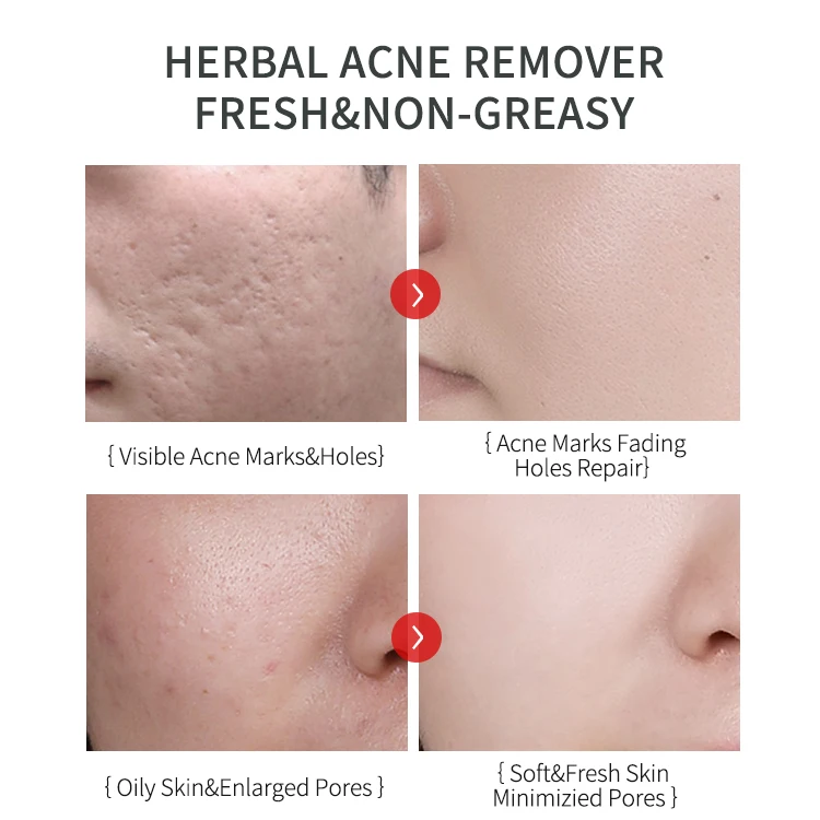 OEM/ODM Limpiador 30g Acne Removal Herbal Extract Skin Care Aloe Vera Acne Removal Gel for Acne Mark Skin