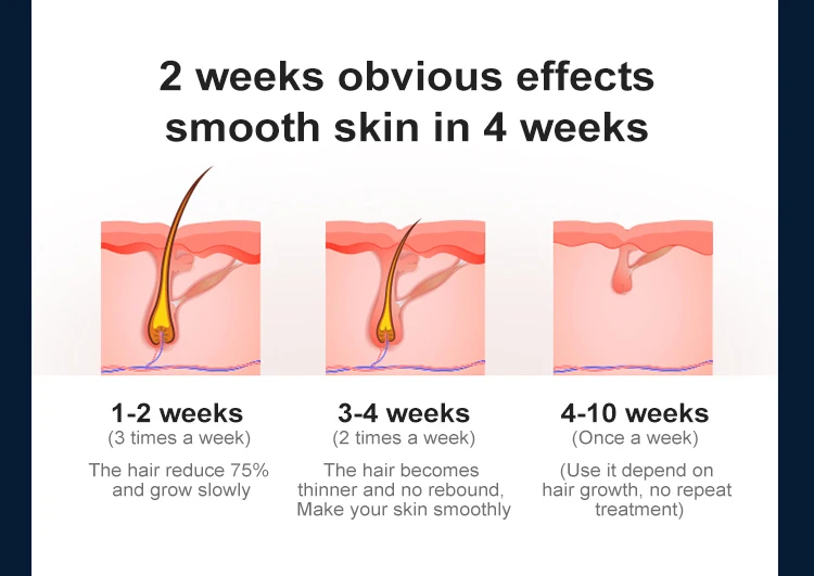 2022 Mismon Home Use Sapphire Electrolysis IPL Hair Removal 999999