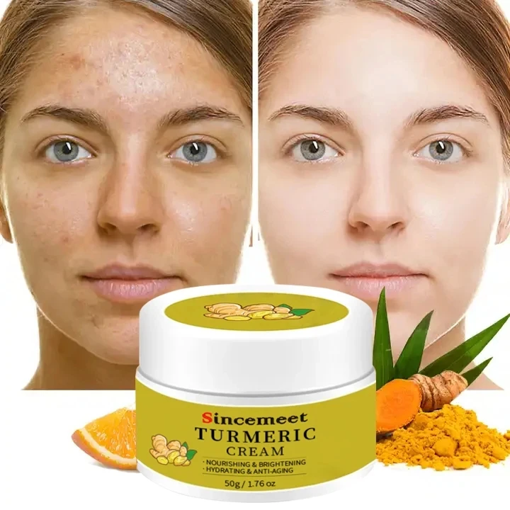 OEM Face Cream Care Removing Dark Spots Acne Treatment Anti Acne Face Vitamin C Cream Turmeric Cream