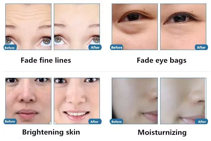 Auto injection skin rejuvenation skin whitening tightening no-needle mesotherapy devices rf meso pre injection mesotherapy gun