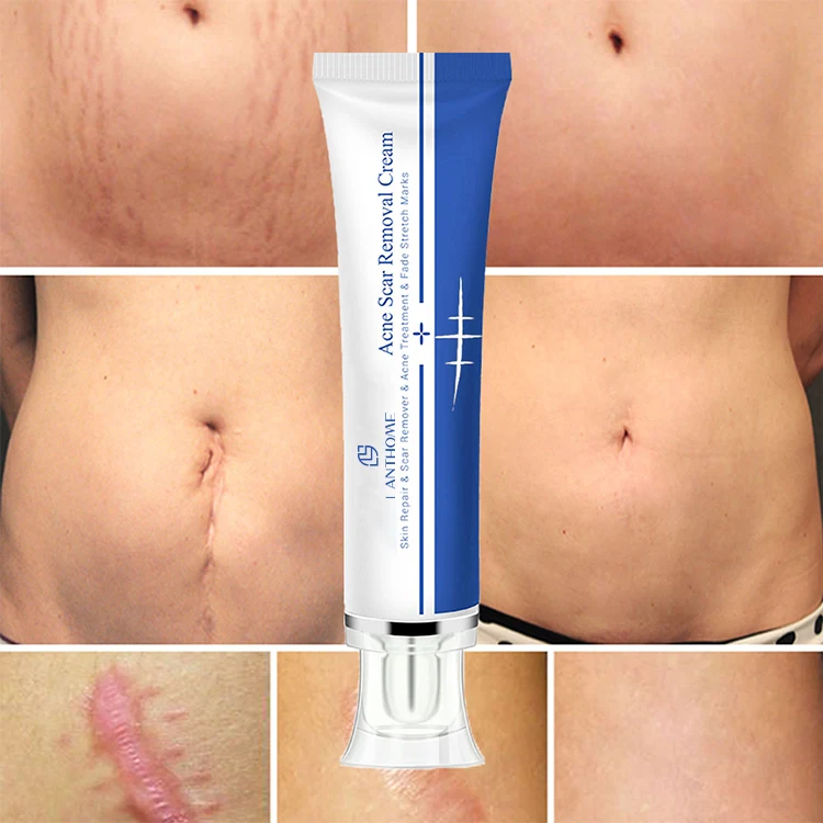 Make Your Own Body Skin Care Skin Repair Remove Clear Pregnancy Scar Removal Stretch Mark Cream