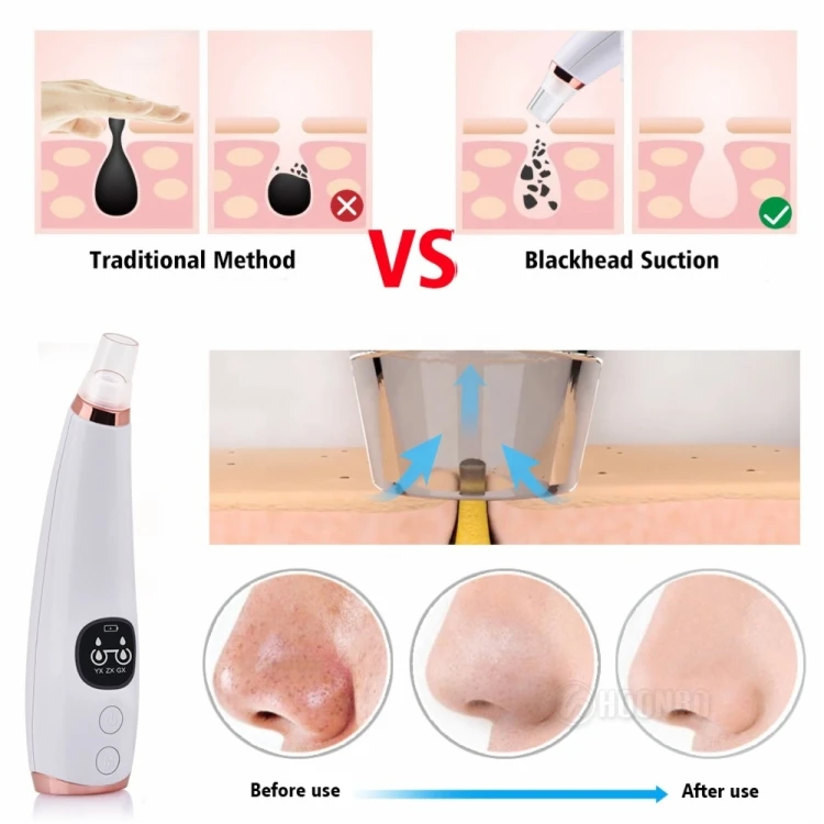 
Custom logo USB Acne Machine Cleaner Skin Care Facial Pore Electric Blackhead Remover Vacuum 