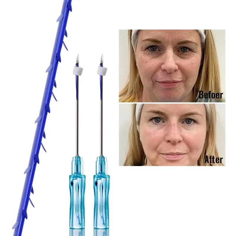 Beauty ce absorbable fox eye brow barbed 4d cog 23g hilos tensores pdo threads lift korea