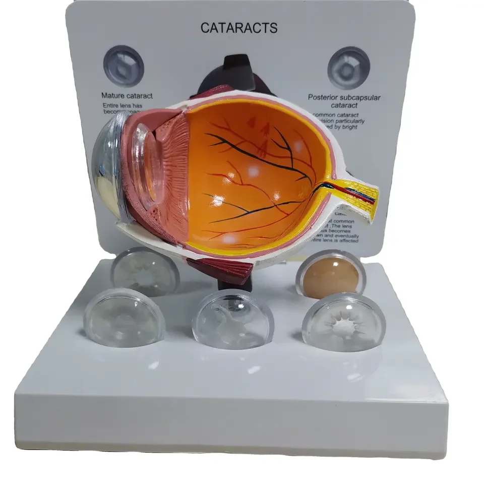 Eye Pathological Anatomical Model For Medical Education Eye Disease Model Of Cataract