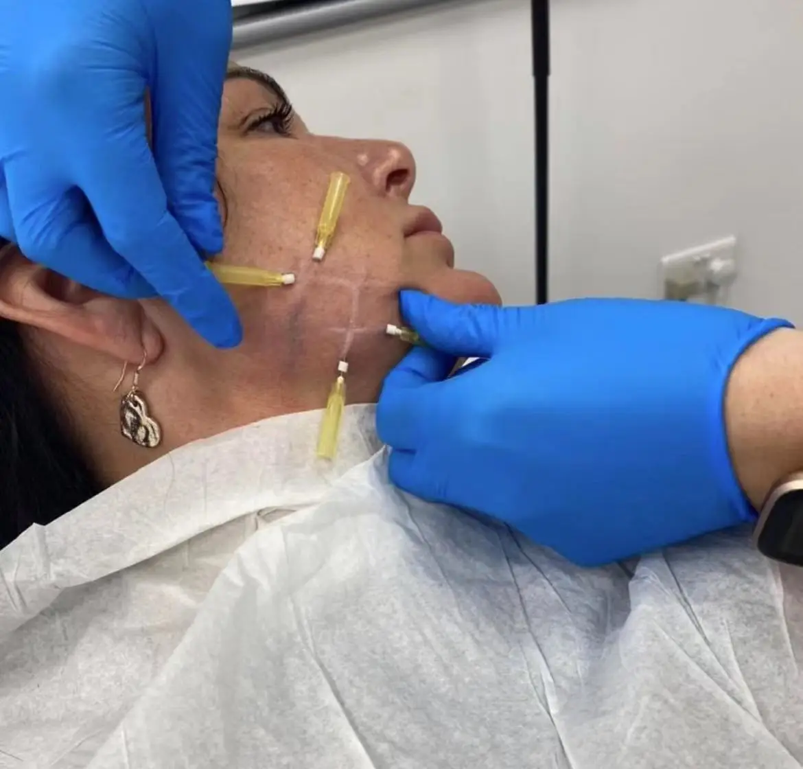 2022 New mono blunt 30g 25mm needle thread lift face eye lift pdo