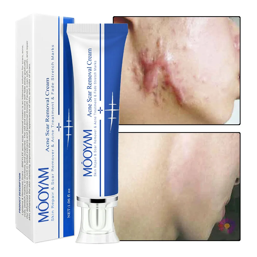 Strong Effective Acne Scar & Pimple Removal Face Gel Stretch Mark Tummy Tuck Tightening Cream Beauty & Personal Care Product