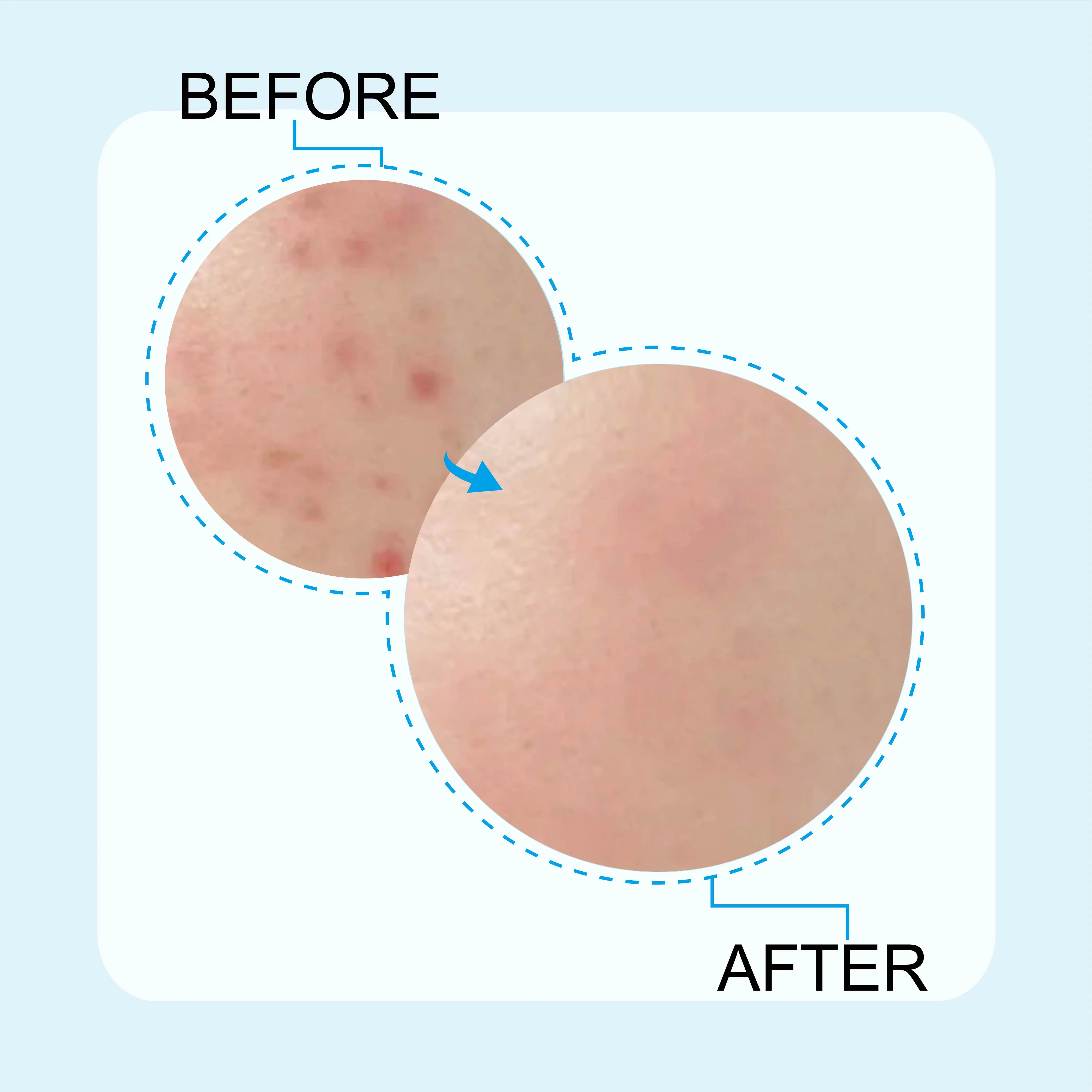 Skin care private label korea vegan acne patches invisible pimple patch with box