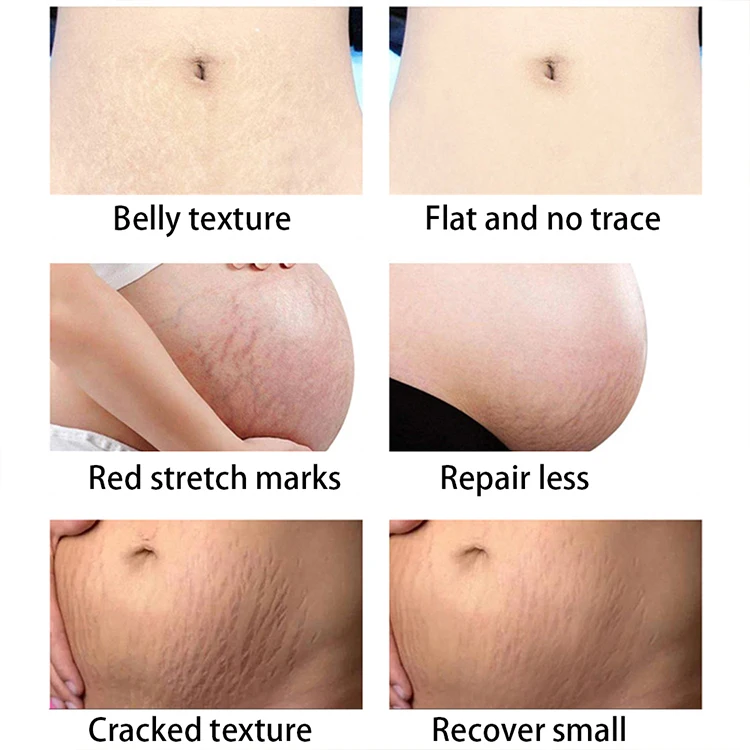 Make Your Own Body Skin Care Skin Repair Remove Clear Pregnancy Scar Removal Stretch Mark Cream