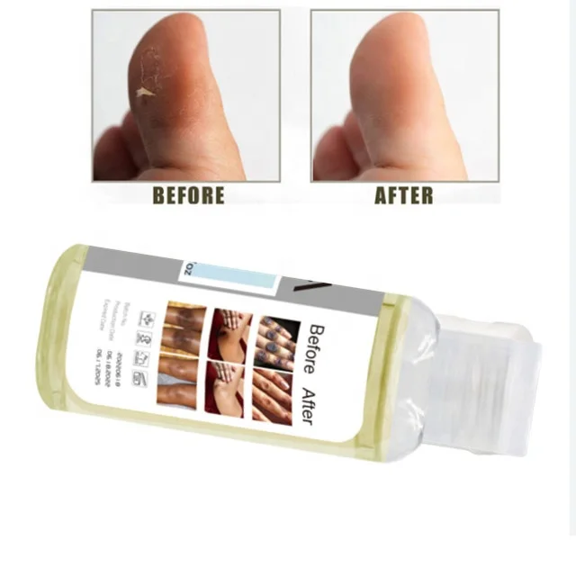 Private Label Extra Strong Peeling Knuckle Oil Whitening Yellow Peeling Oil