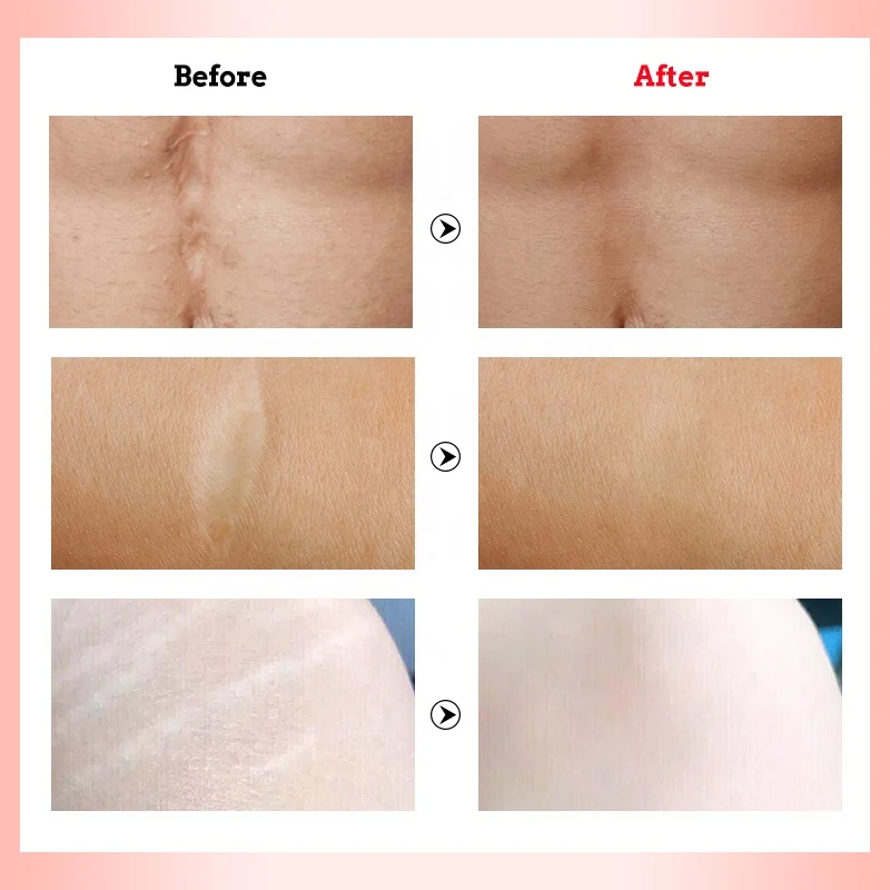 Лидер продаж, Камбоджа, крем для удаления шрамов и темных следов от растяжек для беременных