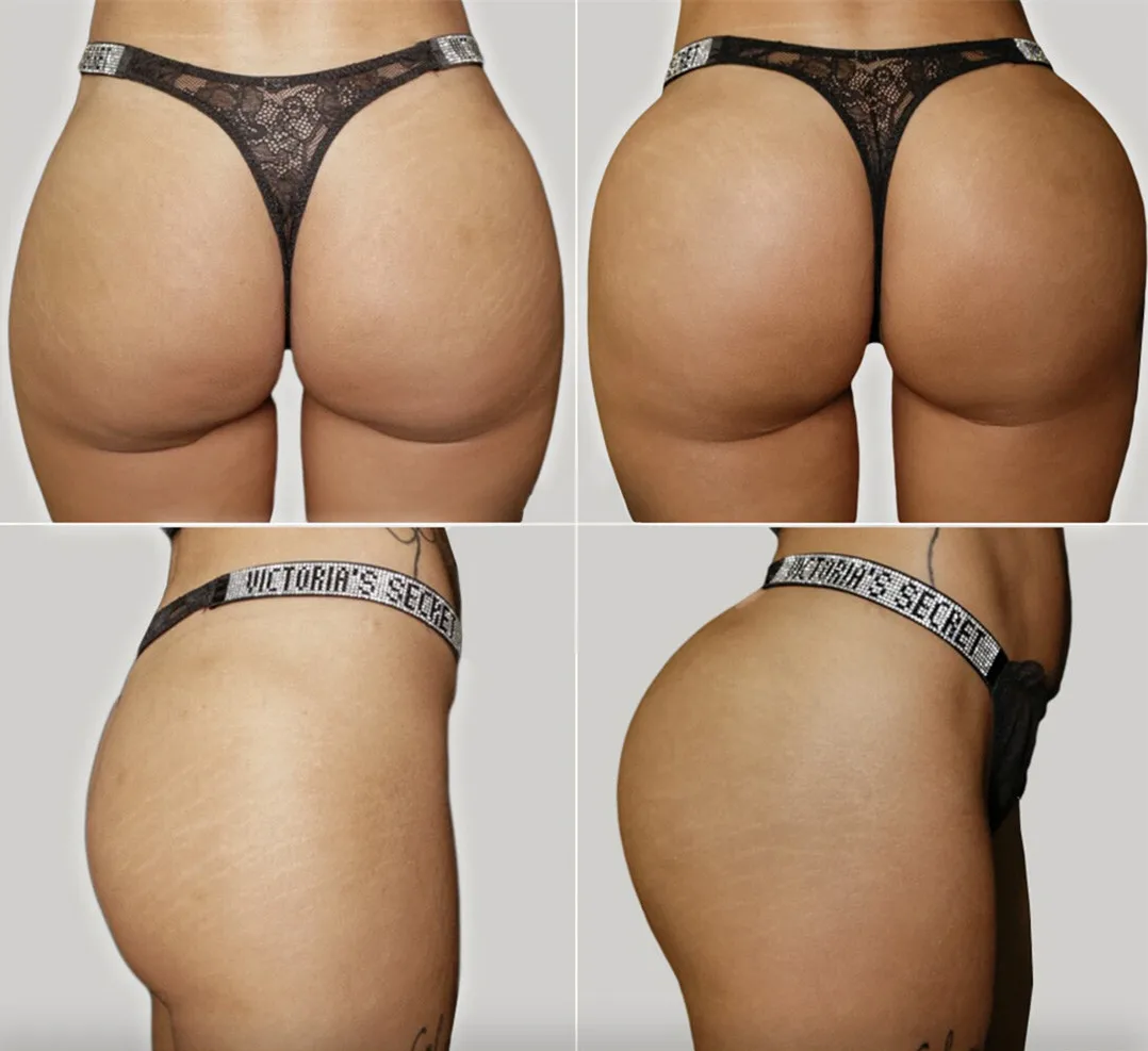 Wholesale price Korean Male Penis  Implants Enlarging penile  Syringe Hyaluronic Acid Injection Enlargement Of penis