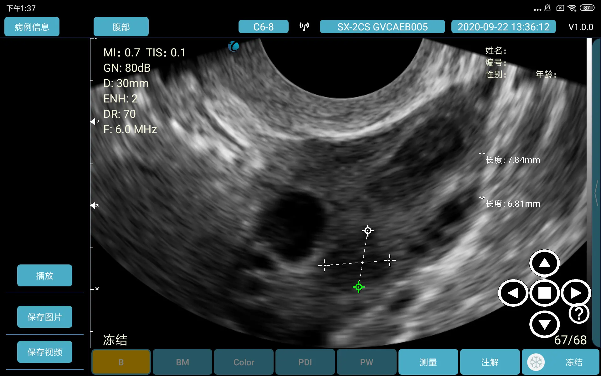 convex and micro convex wireless handheld ultrasound portable for vaginal gyn devices ultrasound portable with low price